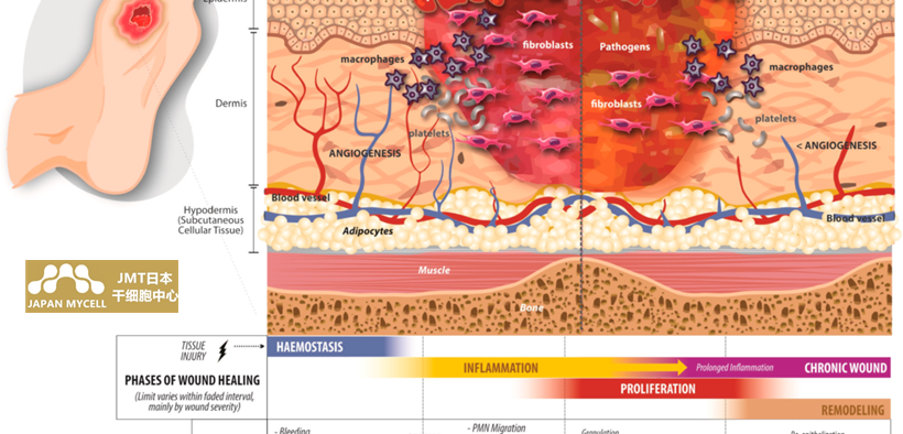 JMT日本干细胞治疗糖尿病-糖尿病足（并发症）的干细胞治疗