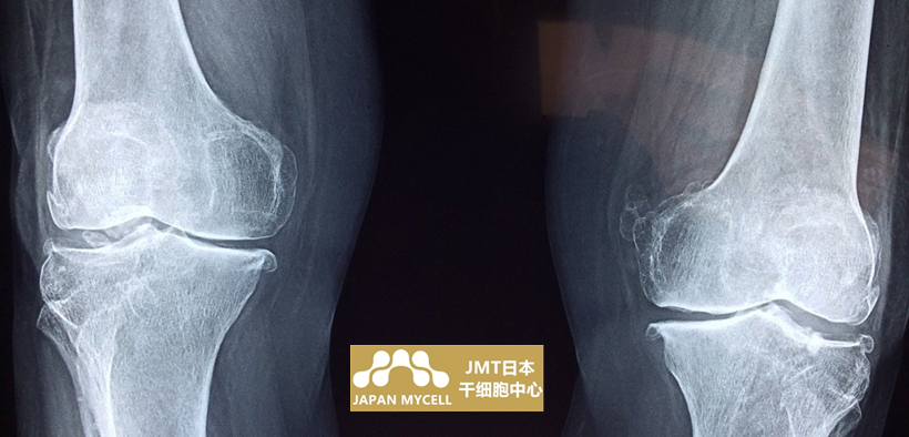 JMT日本干细胞-日本干细胞治疗膝关节疾病流程