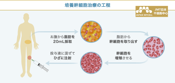 JMT日本干细胞-日本干细胞治疗膝关节疾病的效果介绍