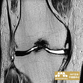 JMT日本干细胞-日本干细胞治疗膝关节疾病案例
