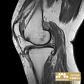 JMT日本干细胞-日本干细胞治疗膝关节疾病案例