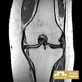 JMT日本干细胞-日本干细胞治疗膝关节疾病案例