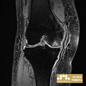 JMT日本干细胞-日本干细胞治疗膝关节疾病案例