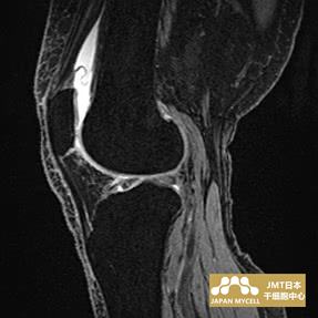JMT日本干细胞-日本干细胞治疗膝关节疾病案例