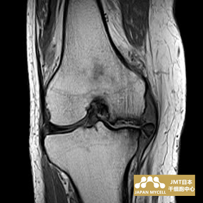 JMT日本干细胞-日本干细胞治疗膝关节疾病案例