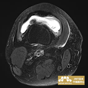 JMT日本干细胞-日本干细胞治疗膝关节疾病案例