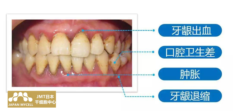 JMT日本干细胞治疗牙周病-关于牙周病的疑问解答①