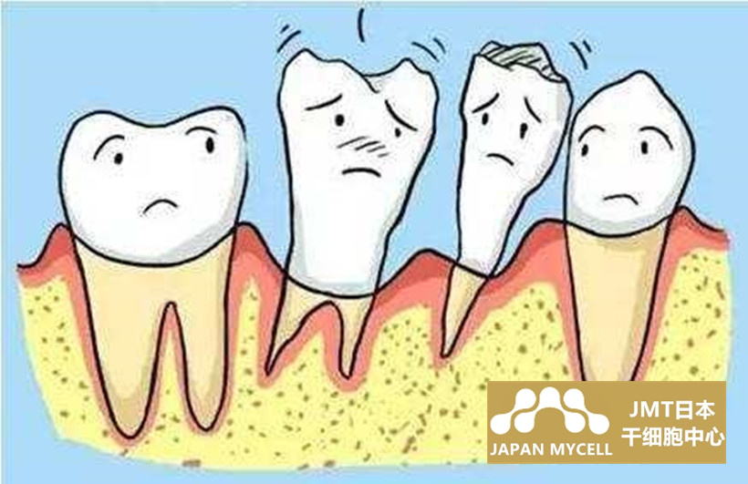 JMT日本干细胞治疗牙周病-关于牙周病的疑问解答②