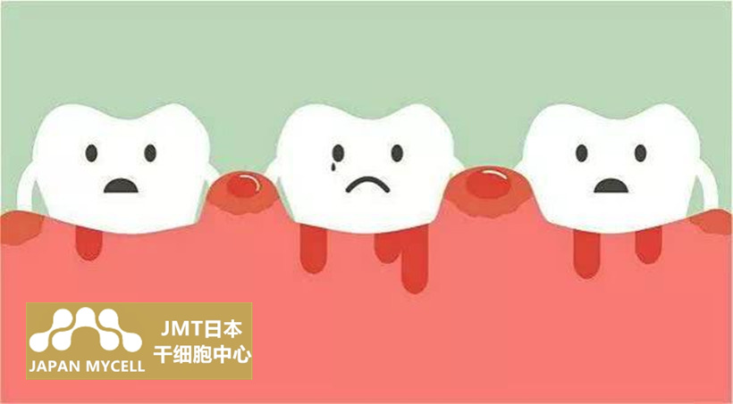 JMT日本干细胞治疗牙周病-关于牙周病的疑问解答③