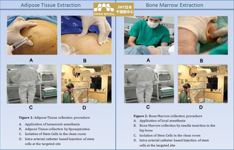 JMT日本干细胞-干细胞抗衰老的流程及注意事项