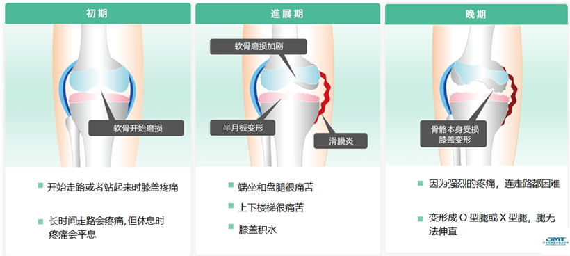 JMT日本干细胞-干细胞治疗膝盖疼痛、变形性膝关节病的介绍