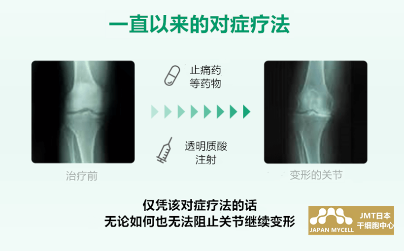 JMT日本干细胞-干细胞治疗膝盖疼痛、变形性膝关节病的介绍