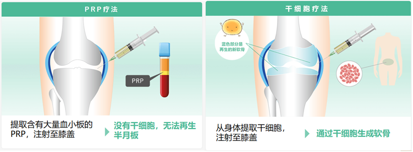 JMT日本干细胞-干细胞治疗膝盖疼痛、变形性膝关节病的介绍