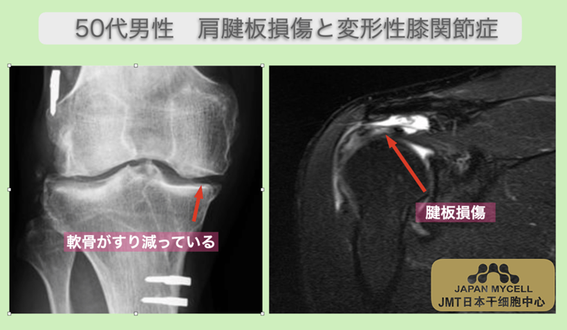 JMT日本干细胞案例-50多岁日本男性右肩袖损伤和右变形性膝关节症的干细胞治疗