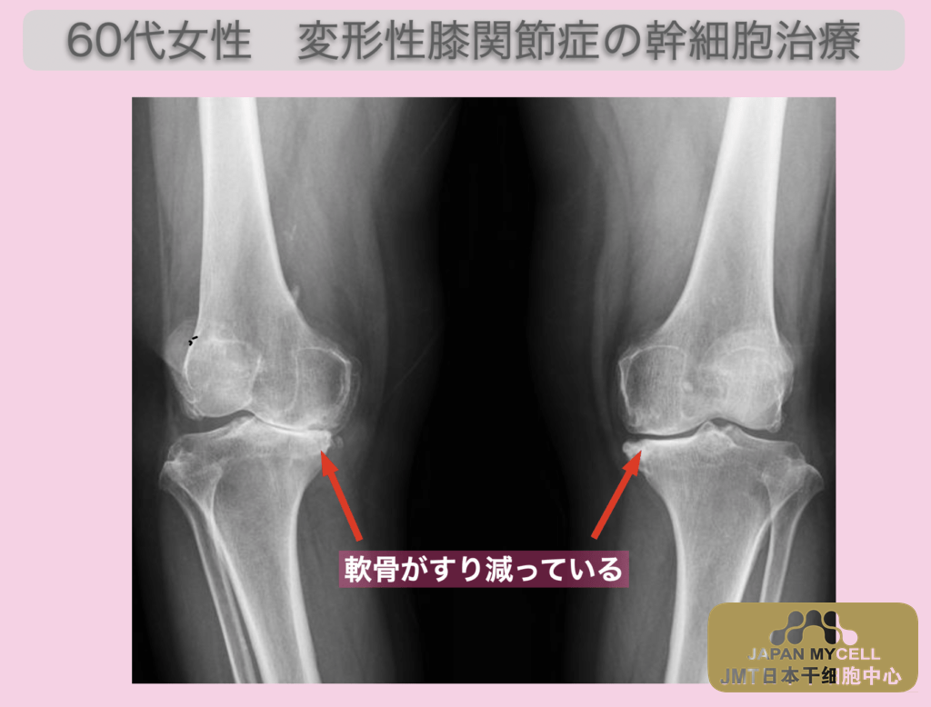 JMT日本干细胞案例-60多岁日本女性变形性膝关节症末期变形严重走路困难的干细胞治疗