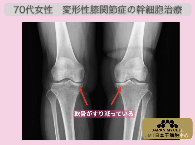 JMT日本干细胞案例-70多岁日本女性变形性膝关节症的干细胞治疗