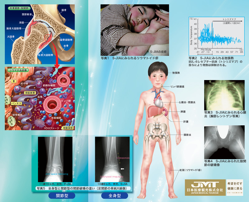 JMT日本疑难病治疗-原因不明的幼年特发性关节炎