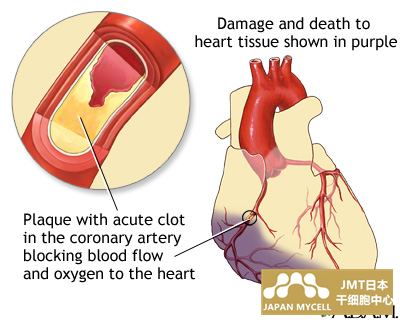 JMT日本干细胞-干细胞改善心肌梗塞后的心功能