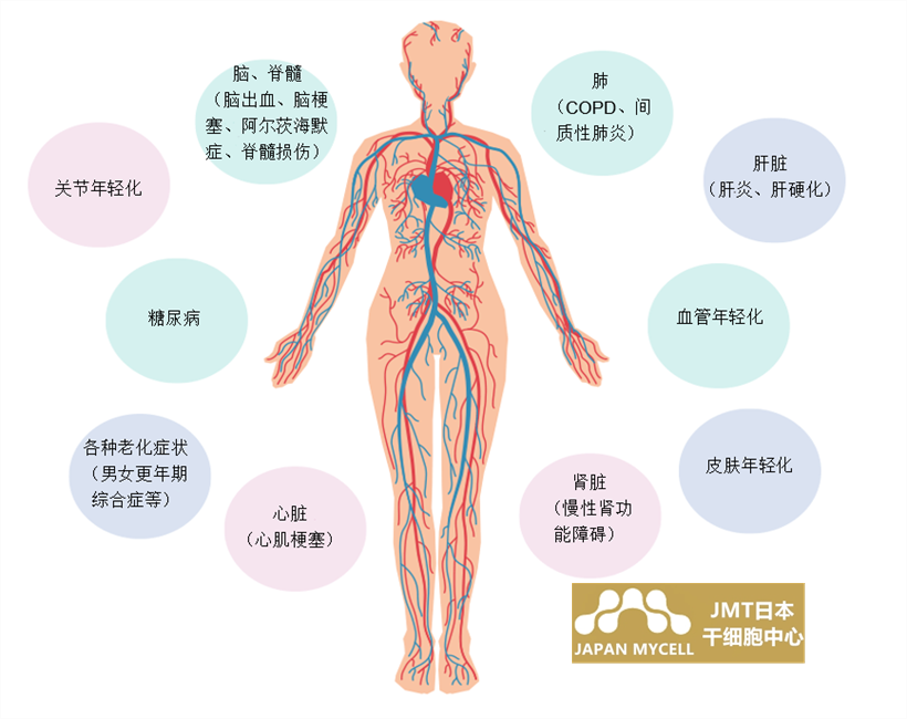 JMT日本干细胞-心源性脑栓塞脑中风的治疗方法