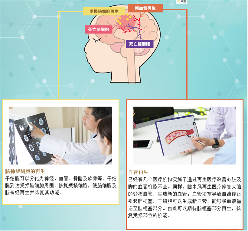 JMT日本干细胞-心源性脑栓塞脑中风的治疗方法