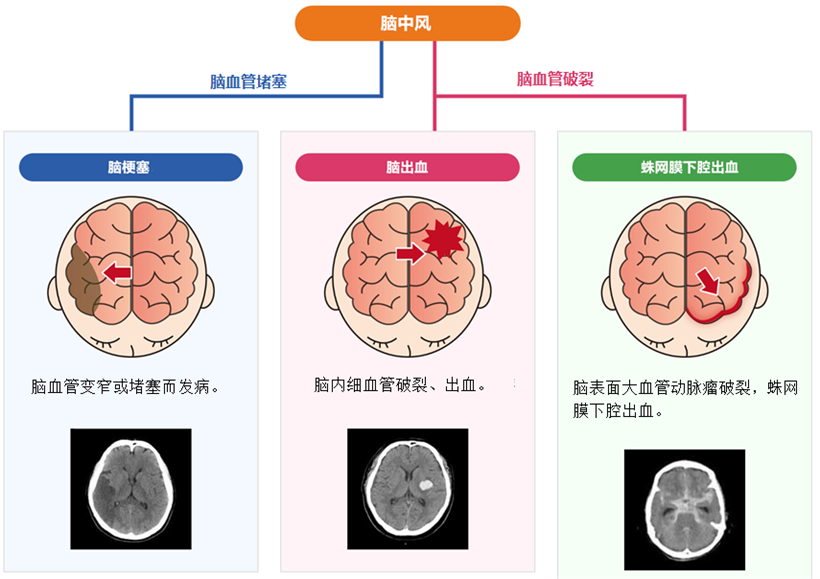 JMT日本干细胞-干细胞如何治疗脑中风、脑中风的类型