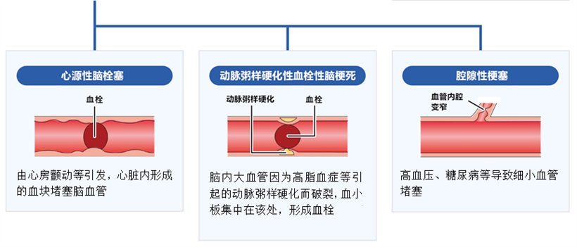 JMT日本干细胞-干细胞如何治疗脑中风、脑中风的类型