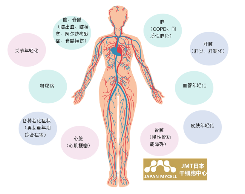 JMT日本干细胞-干细胞如何治疗脑中风、脑中风的类型