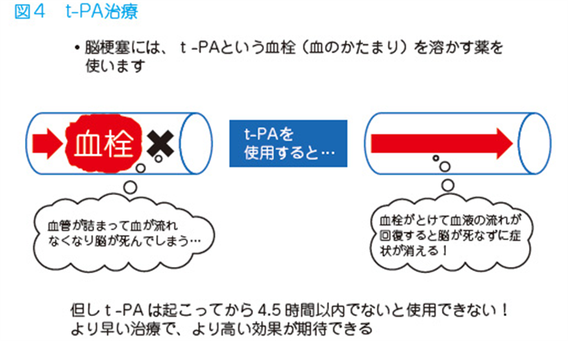 JMT日本干细胞-脑梗脑中风脑出血干细胞及其他治疗方法