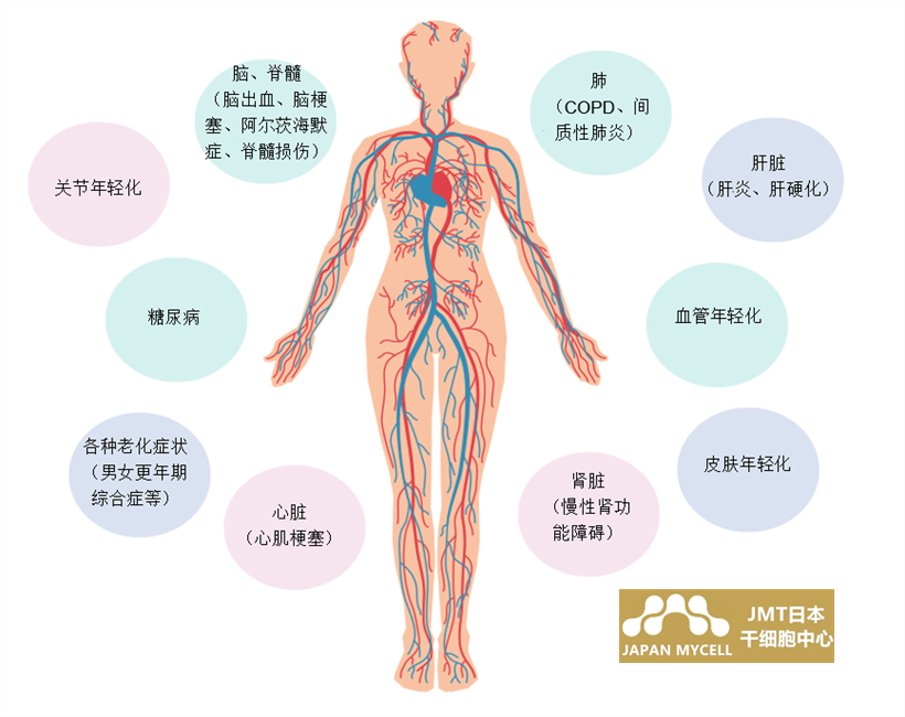 JMT日本干细胞-脑中风脑梗脑出血易患人群及干细胞治疗