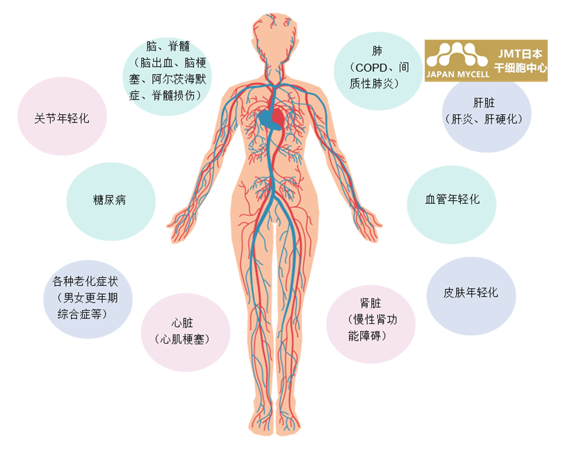 JMT日本干细胞-心肌梗塞的干细胞治疗