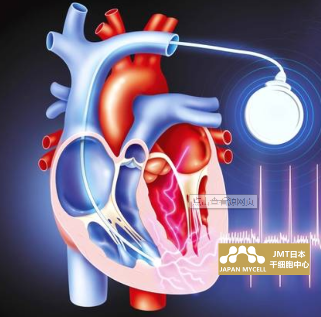 JMT日本干细胞-心脑血管心脏病的干细胞治疗说明
