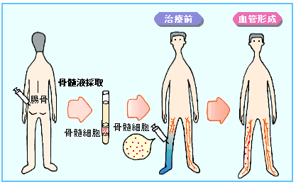 JMT日本干细胞-心脑血管干细胞治疗的现状