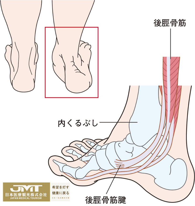 JMT日本医疗-中老年女性因加龄和扭伤引起的胫后肌腱功能障碍