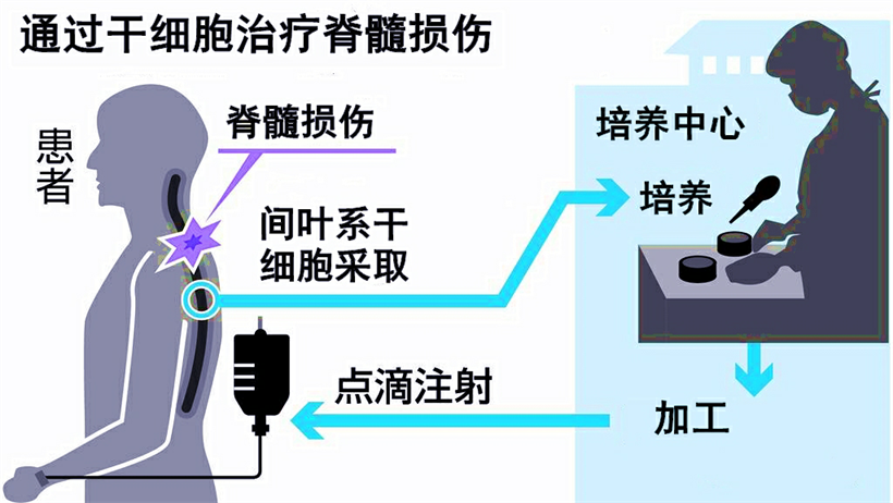 JMT日本干细胞-干细胞治疗脊椎损伤瘫痪