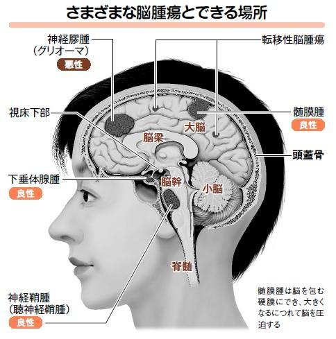 JMT日本看病-视野欠缺是脑膜瘤的征兆？听力下降也是！