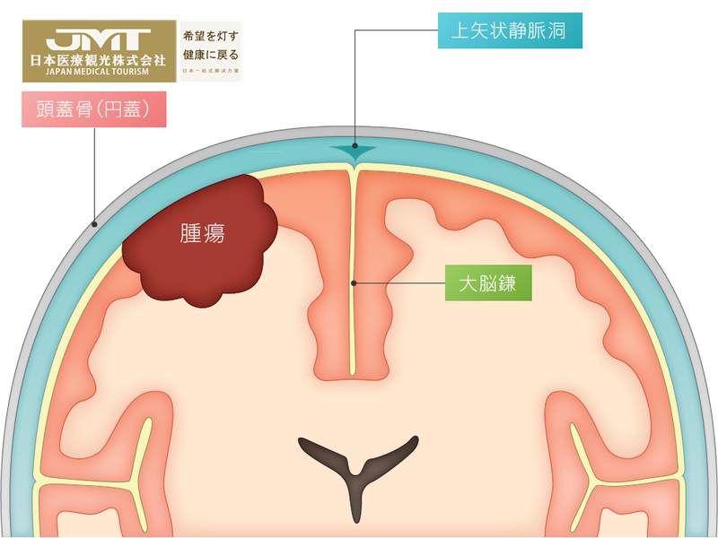 JMT日本看病-视野欠缺是脑膜瘤的征兆？听力下降也是！