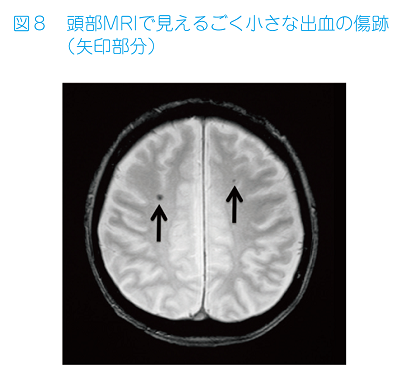 JMT日本干细胞-脑中风脑出血脑梗的康复及干细胞治疗