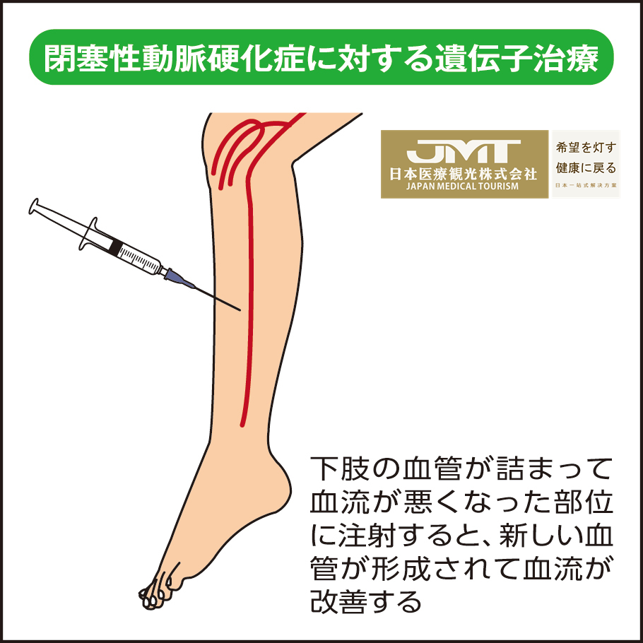 JMT日本医疗-闭塞性动脉硬化症治疗新药Collategene有望于5年内获正式批准