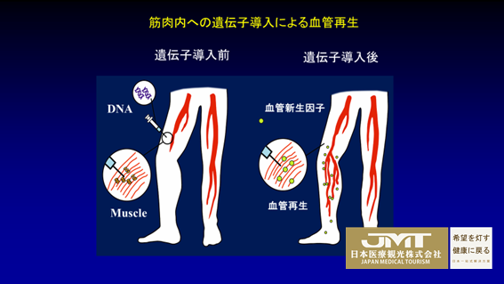 JMT日本医疗-闭塞性动脉硬化症治疗新药Collategene有望于5年内获正式批准