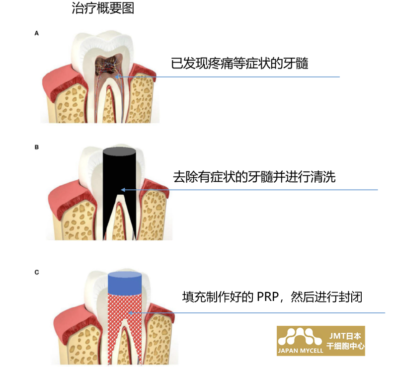 JMT日本干细胞-牙周炎干细胞治疗之利用富血小板血浆进行再生牙髓治疗