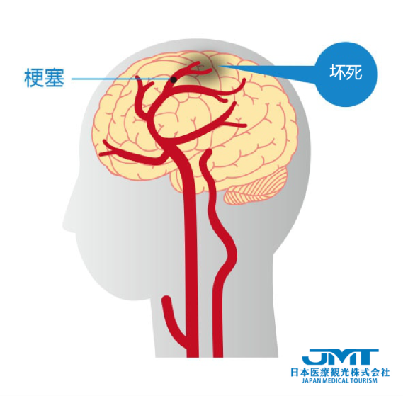 JMT日本医疗-中国脑梗塞发病率世界第一，脑梗的血管内治疗方式详解