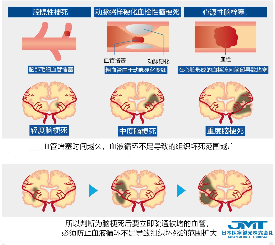 JMT日本医疗-中国脑梗塞发病率世界第一，脑梗的血管内治疗方式详解