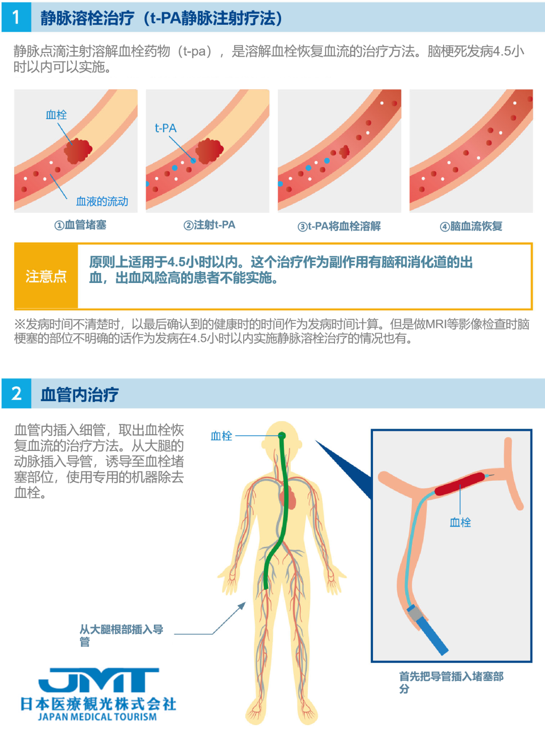 JMT日本医疗-中国脑梗塞发病率世界第一，脑梗的血管内治疗方式详解