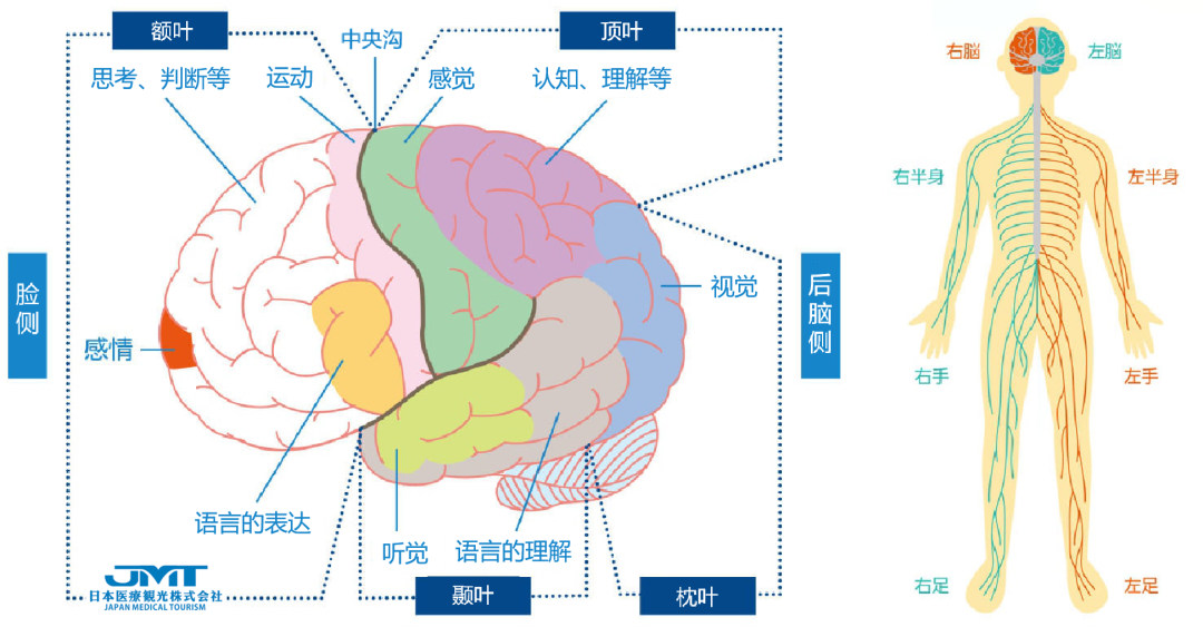 JMT日本医疗-中国脑梗塞发病率世界第一，脑梗的血管内治疗方式详解