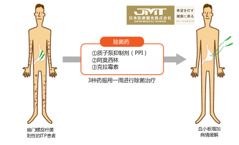 JMT日本医疗-原发免疫性血小板减少症（ITP）的日本治疗