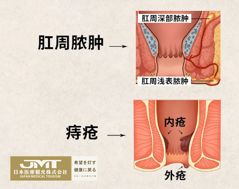 JMT日本医疗-痔疮、肛周脓肿是否有发展成直肠癌的风险