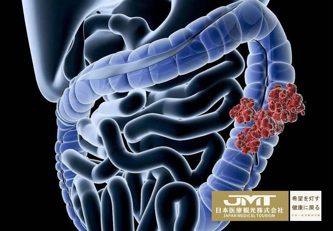 JMT日本医疗-痔疮、肛周脓肿是否有发展成直肠癌的风险