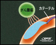 JMT日本医疗-负担轻效果好—癌症的血管内治疗