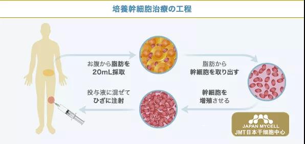 JMT日本干细胞-日本人如何治疗变形性膝关节症