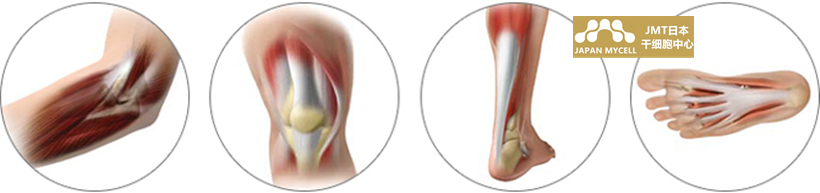 JMT日本干细胞-膝盖手肘肩腰关节的干细胞治疗